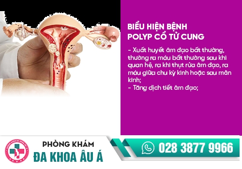 Polyp tử cung gây ra tình trạng chảy máu âm đạo bất thường
